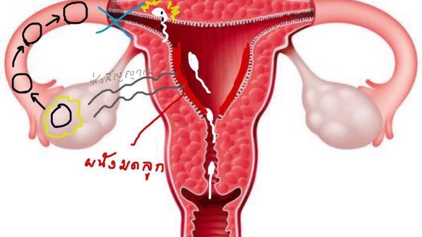 ท่อนำไข่ตันแล้วทำไมเมนส์ถึงมาปกติ