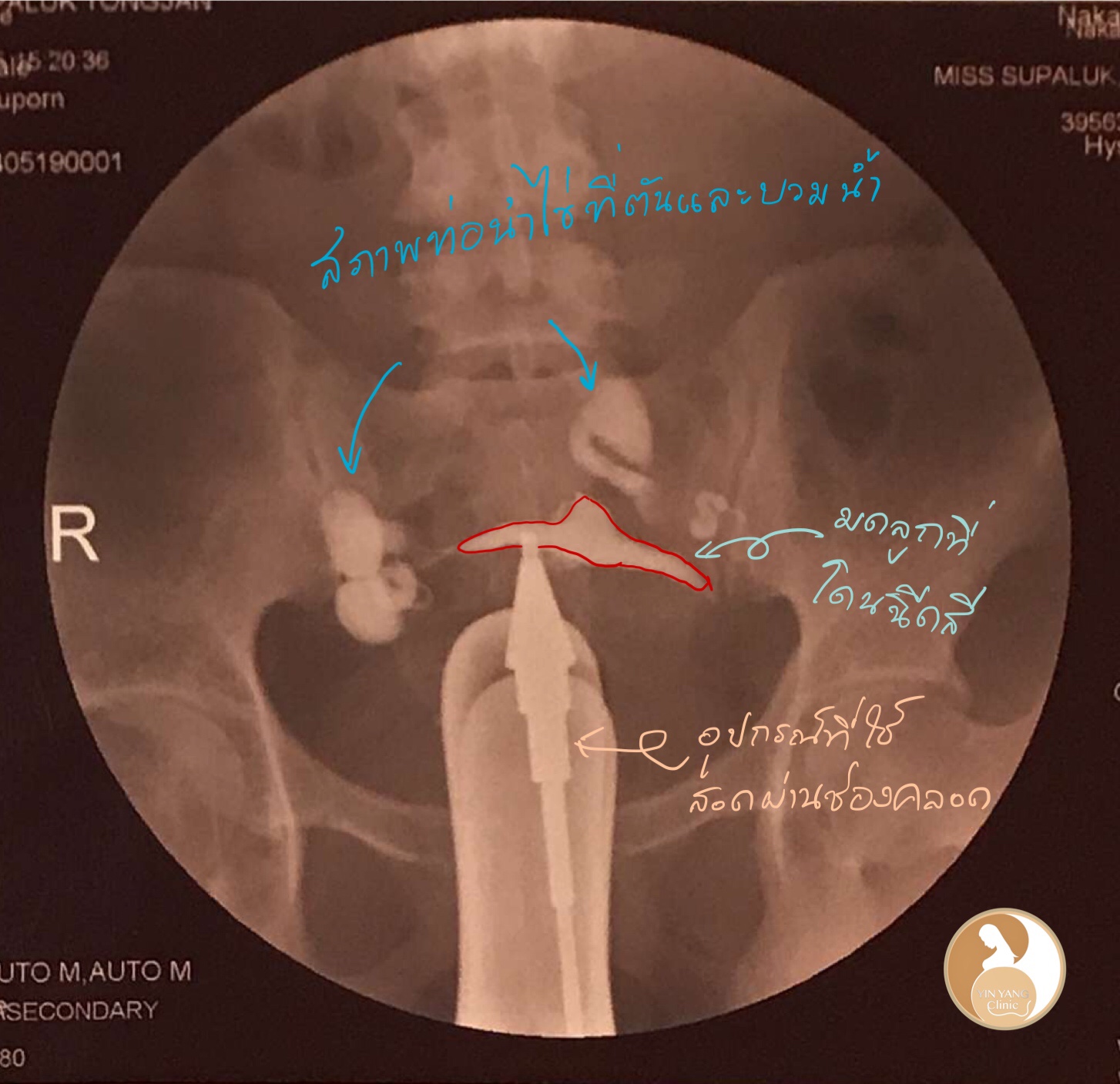 แชร์ประสบการณ์ภาวะมีบุตรยากจากท่อนำไข่ตันและ PCOS