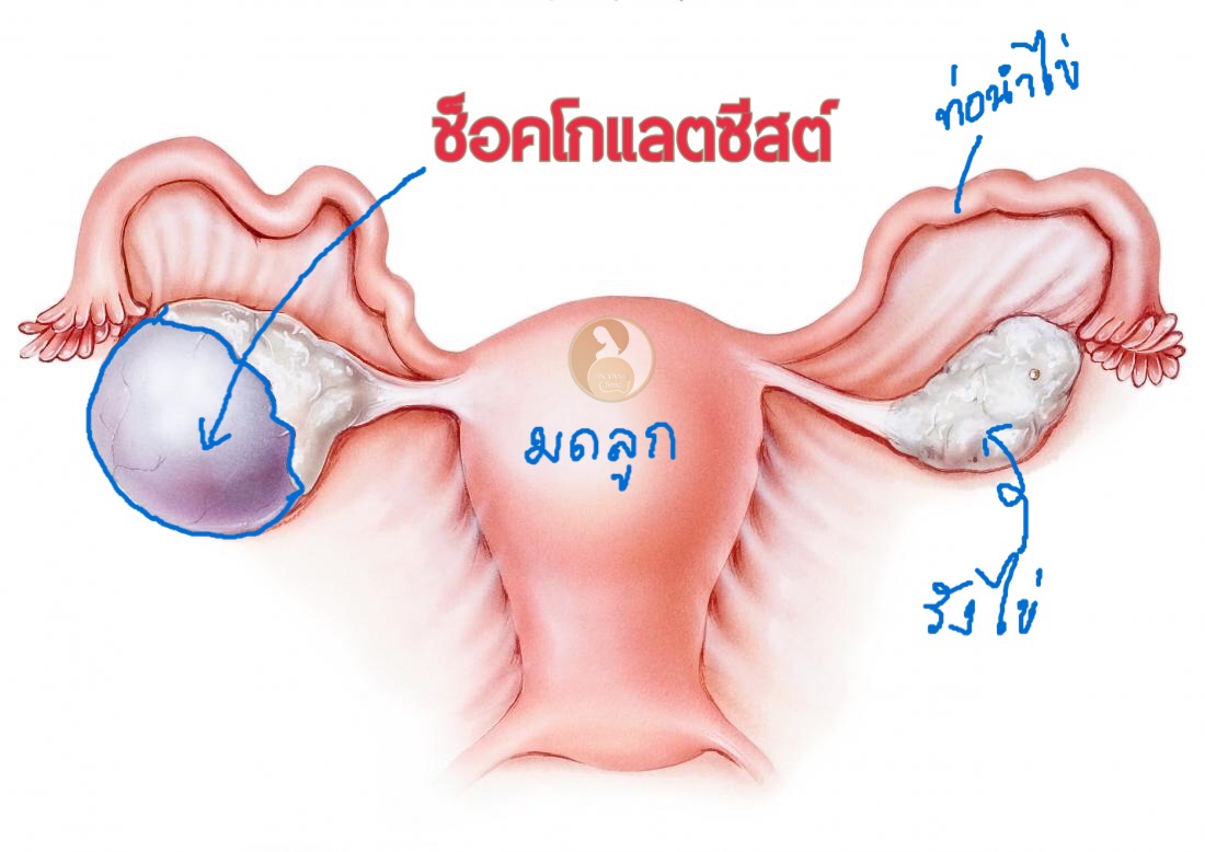 ช็อกโกแลตซีสต์กับหมอจีน…เราทำอะไรได้บ้าง.