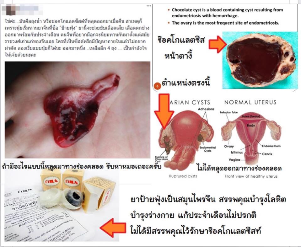 ช็อกโกแลตซีสต์ขับออกจากมดลูกได้ด้วยยาป่ายฟุ่ง?