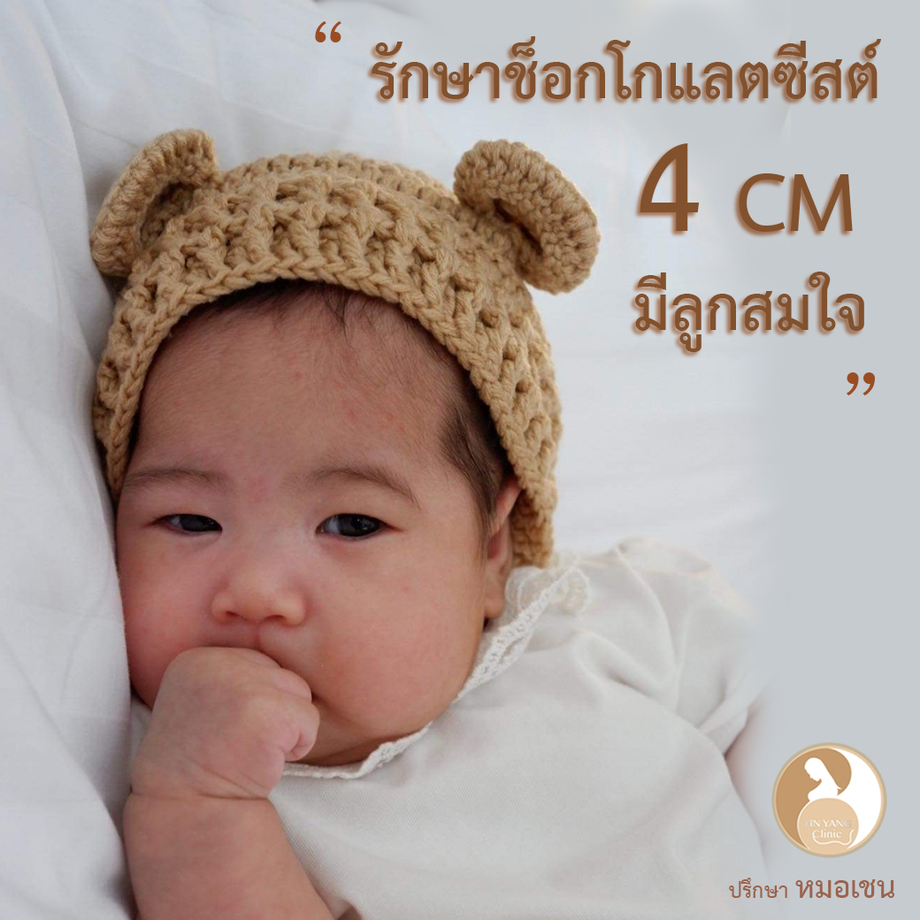 รักษาช็อกโกแลตซีสต์ 4 cm มีลูกสมใจ