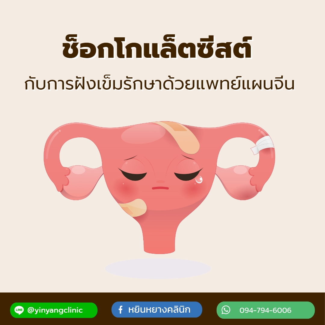 ช็อกโกแล็ตซีสต์กับการฝังเข็มรักษาด้วยแพทย์แผนจีน